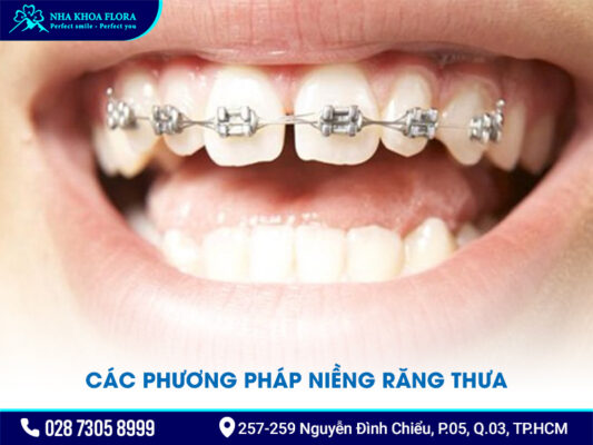 Niềng răng thưa 1 hàm giá bao nhiêu - ảnh 3 Niềng răng thưa 1 hàm giá bao nhiêu - ảnh 3