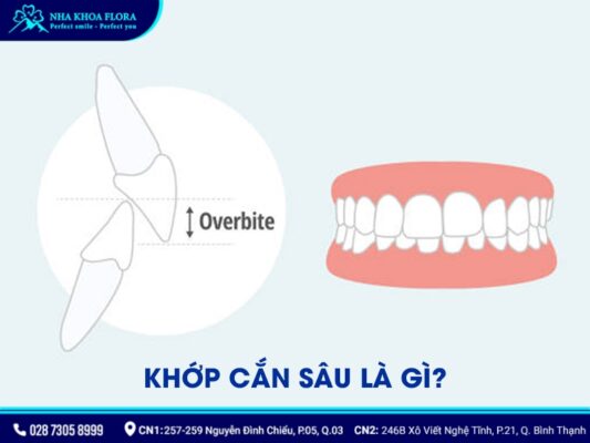 quy trình niềng răng khớp cắn sâu - ảnh 1 quy trình niềng răng khớp cắn sâu - ảnh 1