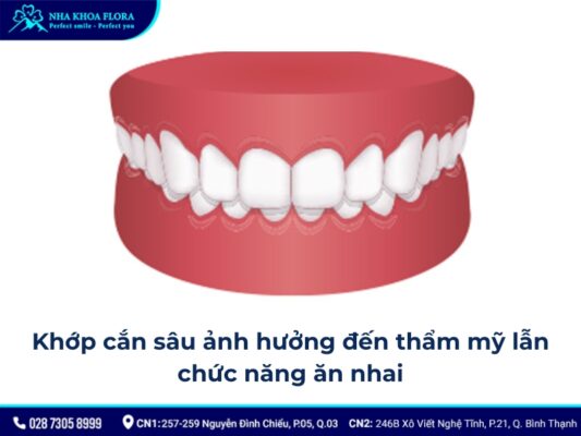 quy trình niềng răng khớp cắn sâu - ảnh 2 quy trình niềng răng khớp cắn sâu - ảnh 2