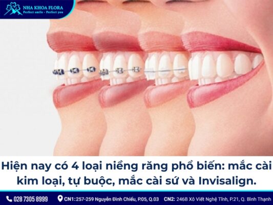 quy trình niềng răng khớp cắn sâu - ảnh 3 quy trình niềng răng khớp cắn sâu - ảnh 3