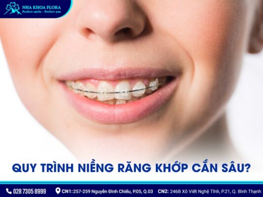 quy trình niềng răng khớp cắn sâu - ảnh 4 quy trình niềng răng khớp cắn sâu - ảnh 4