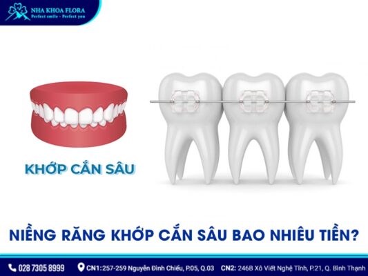 quy trình niềng răng khớp cắn sâu - ảnh 6 quy trình niềng răng khớp cắn sâu - ảnh 6