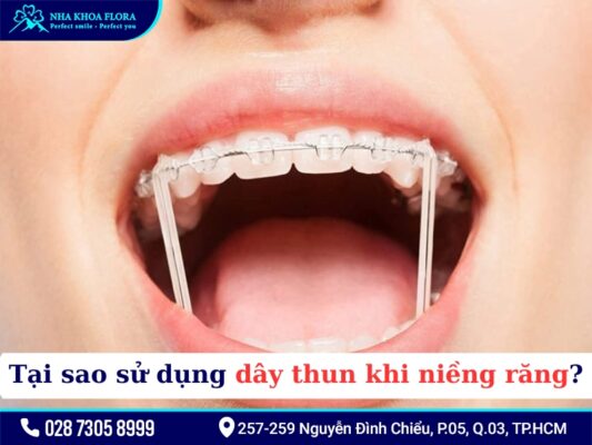 Thun niềng răng - ảnh 2 Thun niềng răng - ảnh 2