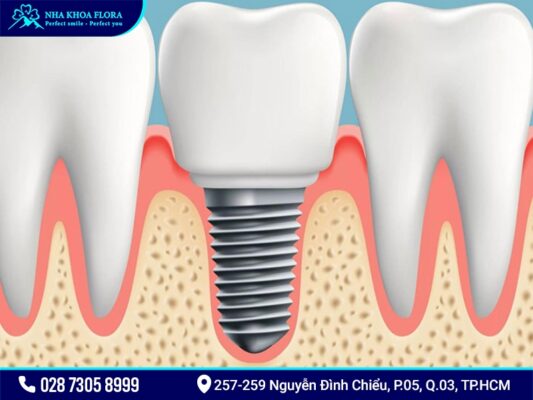 etk implant Pháp - ảnh 3 etk implant Pháp - ảnh 3
