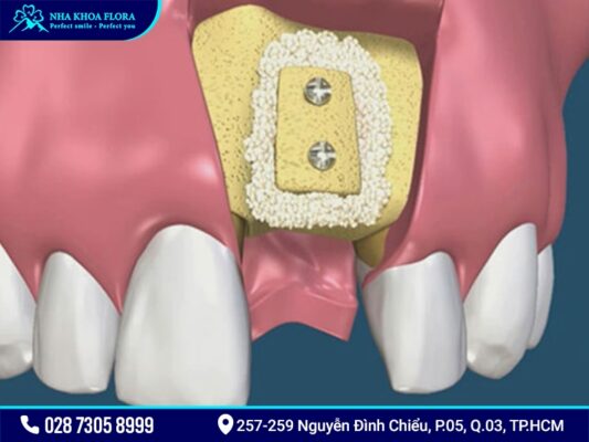 Cấy ghép xương để cắm Implant có mắc không? - ảnh 1 Cấy ghép xương để cắm Implant có mắc không? - ảnh 1