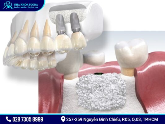 Cấy ghép xương để cắm Implant có mắc không? - ảnh 2 Cấy ghép xương để cắm Implant có mắc không? - ảnh 2