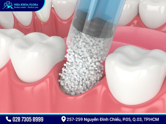 Cấy ghép xương để cắm Implant có mắc không? - ảnh 3 Cấy ghép xương để cắm Implant có mắc không? - ảnh 3