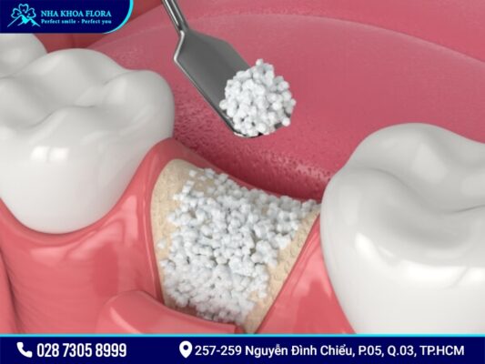 Cấy ghép xương để cắm Implant có mắc không? - ảnh 4 Cấy ghép xương để cắm Implant có mắc không? - ảnh 4