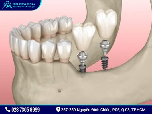 Mini Implant giá bao nhiêu? - ảnh 1 Mini Implant giá bao nhiêu? - ảnh 1