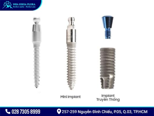 Mini Implant giá bao nhiêu? - ảnh 2 Mini Implant giá bao nhiêu? - ảnh 2