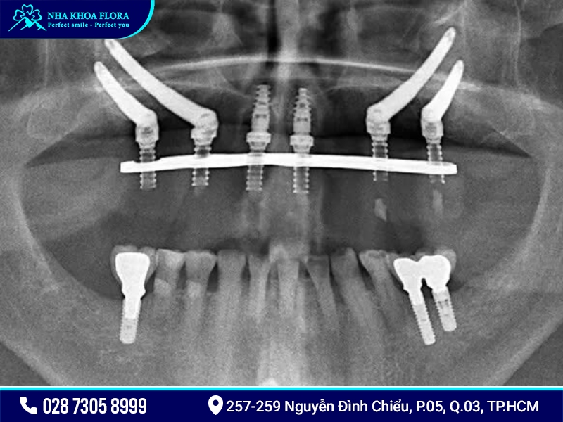 Implant Zygoma
