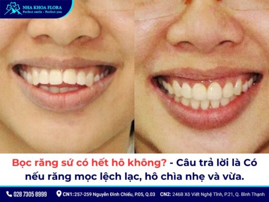 Bọc răng sứ có hết hô không? - ảnh 1 Bọc răng sứ có hết hô không? - ảnh 1