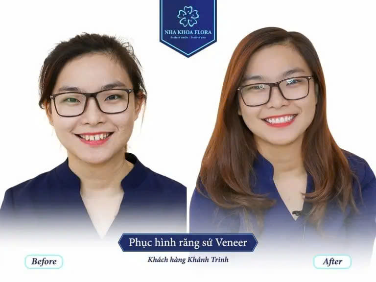 dán sứ veneer