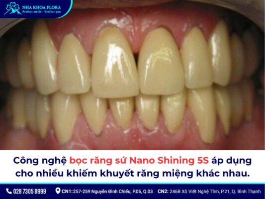 Răng sứ Nano Shining 5S giá bao nhiêu - ảnh 3 Răng sứ Nano Shining 5S giá bao nhiêu - ảnh 3