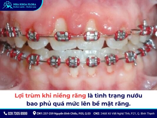 lợi trùm khi niềng răng - ảnh 1 lợi trùm khi niềng răng - ảnh 1