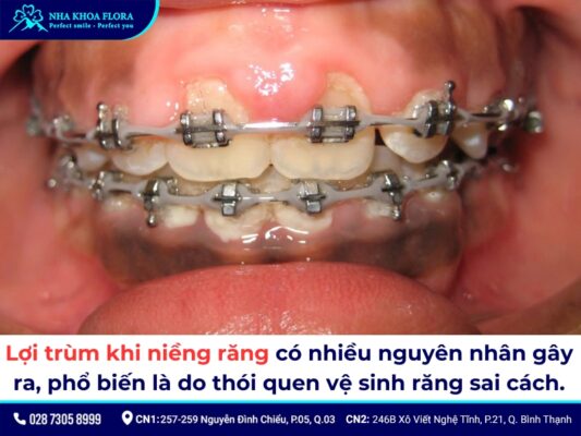 lợi trùm khi niềng răng - ảnh 2 lợi trùm khi niềng răng - ảnh 2