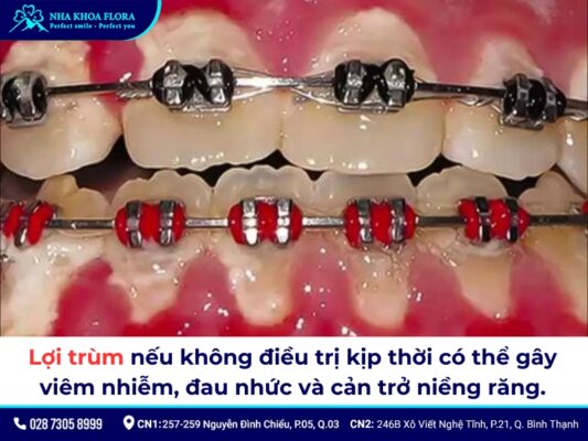 lợi trùm khi niềng răng - ảnh 3 lợi trùm khi niềng răng - ảnh 3