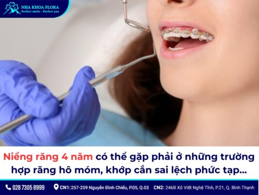 niềng răng 4 năm - ảnh 1 niềng răng 4 năm - ảnh 1