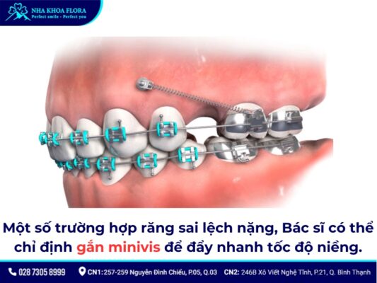 niềng răng 4 năm - ảnh 5 niềng răng 4 năm - ảnh 5
