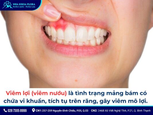 niềng răng bị sưng lợi - ảnh 1 niềng răng bị sưng lợi - ảnh 1