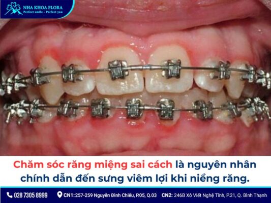 niềng răng bị sưng lợi - ảnh 2 niềng răng bị sưng lợi - ảnh 2