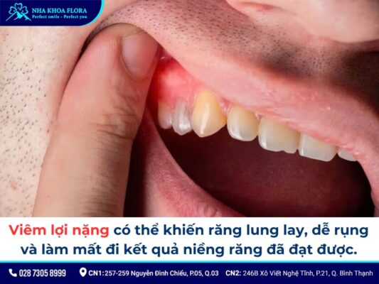 niềng răng bị sưng lợi - ảnh 5 niềng răng bị sưng lợi - ảnh 5