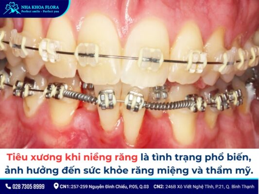 niềng răng bị tiêu xương - ảnh 1 niềng răng bị tiêu xương - ảnh 1
