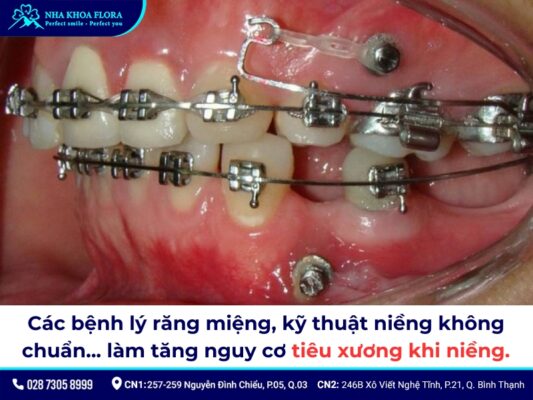 niềng răng bị tiêu xương - ảnh 2 niềng răng bị tiêu xương - ảnh 2