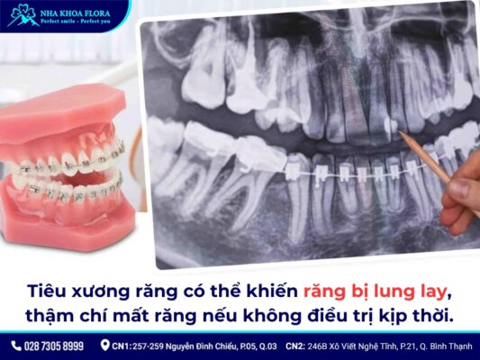 niềng răng bị tiêu xương - ảnh 3 niềng răng bị tiêu xương - ảnh 3