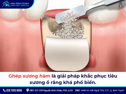niềng răng bị tiêu xương - ảnh 4 niềng răng bị tiêu xương - ảnh 4