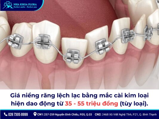 niềng răng lệch lạc giá bao nhiêu - ảnh 1 niềng răng lệch lạc giá bao nhiêu - ảnh 1