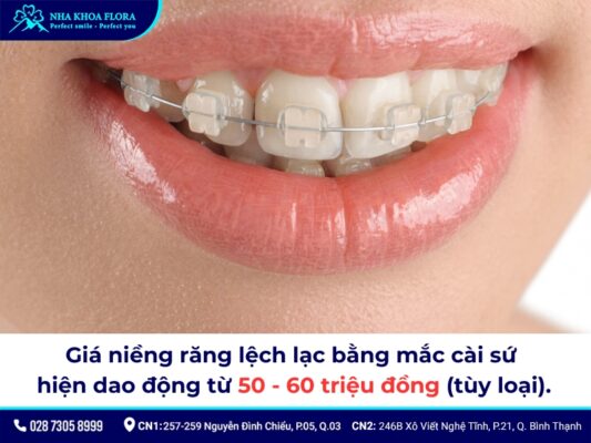 niềng răng lệch lạc giá bao nhiêu - ảnh 2 niềng răng lệch lạc giá bao nhiêu - ảnh 2