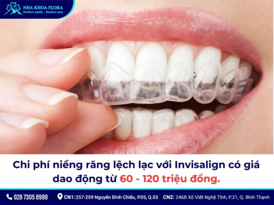 niềng răng lệch lạc giá bao nhiêu - ảnh 3 niềng răng lệch lạc giá bao nhiêu - ảnh 3