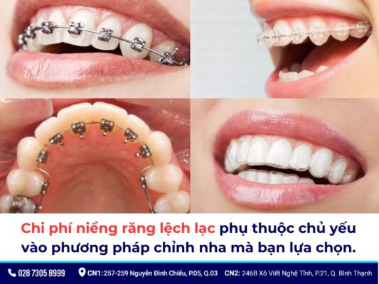 niềng răng lệch lạc giá bao nhiêu - ảnh 4 niềng răng lệch lạc giá bao nhiêu - ảnh 4