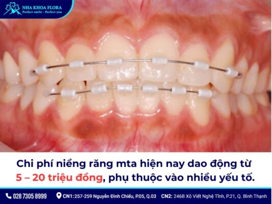 niềng răng mta giá bao nhiêu - ảnh 1 niềng răng mta giá bao nhiêu - ảnh 1