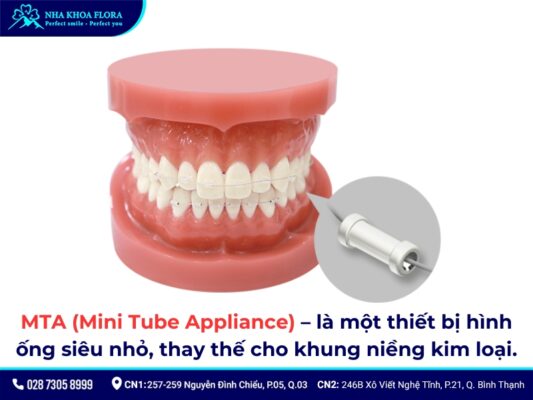 niềng răng mta giá bao nhiêu - ảnh 2 niềng răng mta giá bao nhiêu - ảnh 2