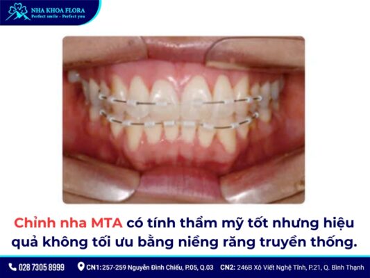 niềng răng mta giá bao nhiêu - ảnh 3 niềng răng mta giá bao nhiêu - ảnh 3