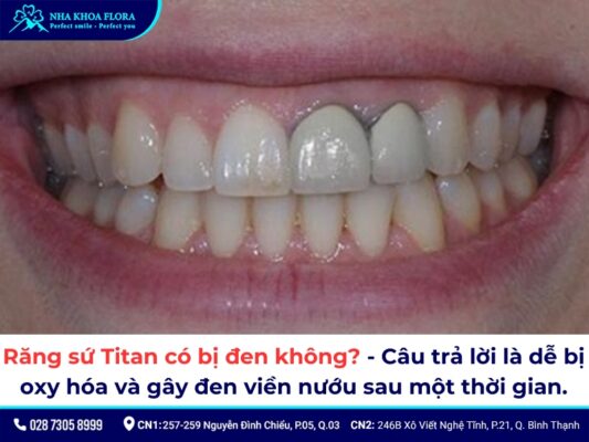 răng sứ Titan có bị đen không - ảnh 1 răng sứ Titan có bị đen không - ảnh 1