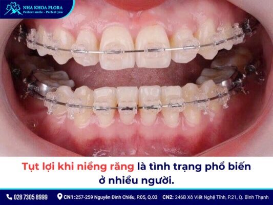 tụt lợi khi niềng răng - ảnh 1 tụt lợi khi niềng răng - ảnh 1
