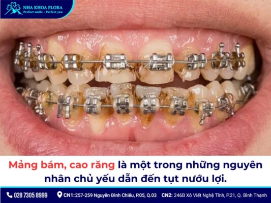 tụt lợi khi niềng răng - ảnh 3 tụt lợi khi niềng răng - ảnh 3