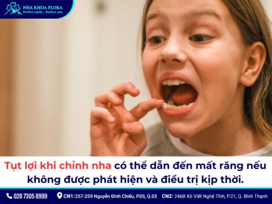 tụt lợi khi niềng răng - ảnh 6 tụt lợi khi niềng răng - ảnh 6