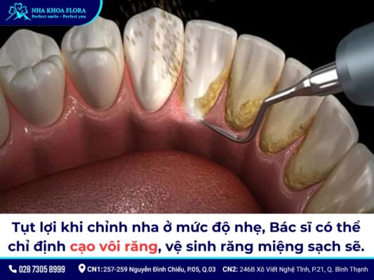 tụt lợi khi niềng răng - ảnh 7 tụt lợi khi niềng răng - ảnh 7