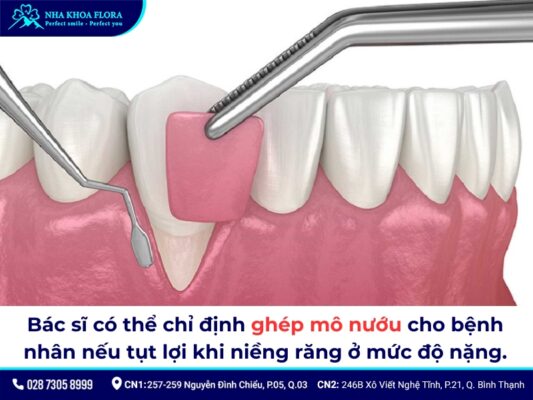 tụt lợi khi niềng răng - ảnh 8 tụt lợi khi niềng răng - ảnh 8