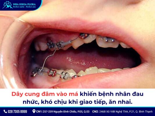 đứt dây cung niềng răng - ảnh 4 đứt dây cung niềng răng - ảnh 4