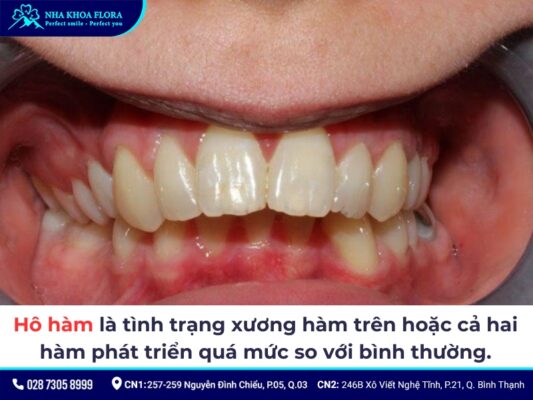 hô hàm có niềng răng được không - ảnh 1 hô hàm có niềng răng được không - ảnh 1