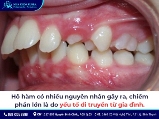 hô hàm có niềng răng được không - ảnh 2 hô hàm có niềng răng được không - ảnh 2
