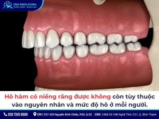 hô hàm có niềng răng được không - ảnh 3 hô hàm có niềng răng được không - ảnh 3
