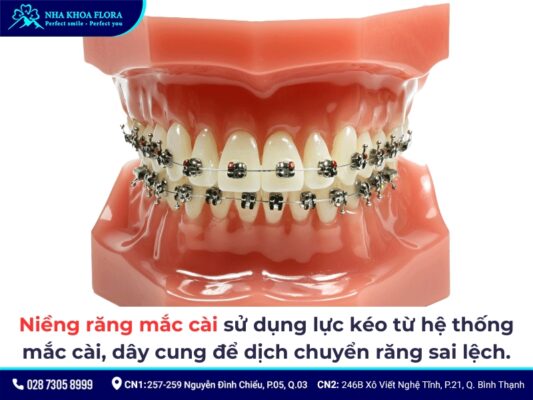 hô hàm có niềng răng được không - ảnh 4 hô hàm có niềng răng được không - ảnh 4