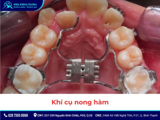 khí cụ niềng răng - ảnh 10 khí cụ niềng răng - ảnh 10