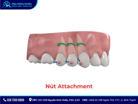 khí cụ niềng răng - ảnh 14 khí cụ niềng răng - ảnh 14